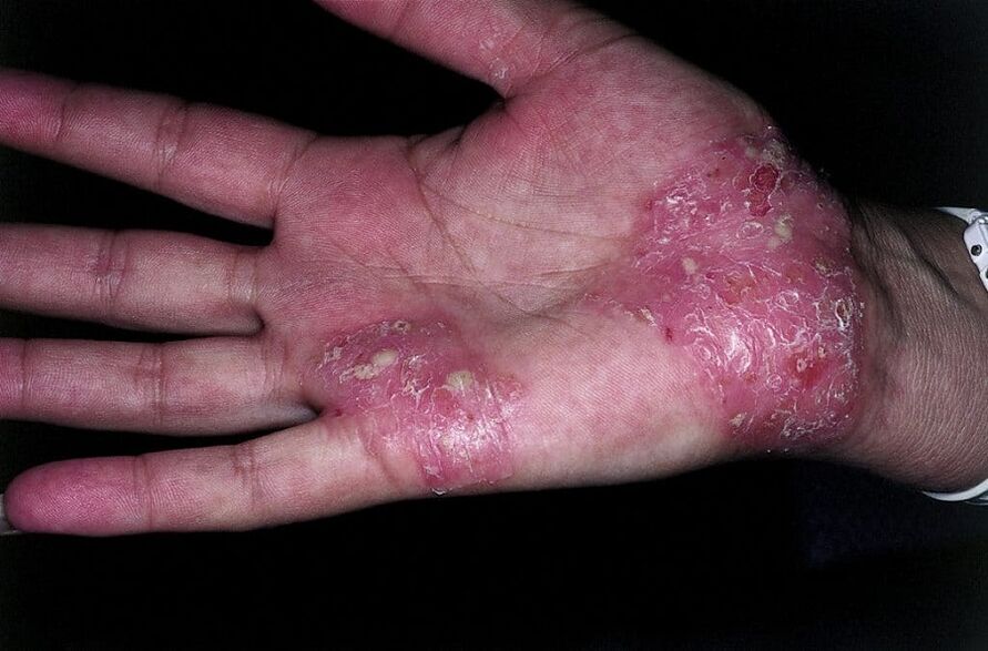 Verschlimmerung der Psoriasis an den Händen
