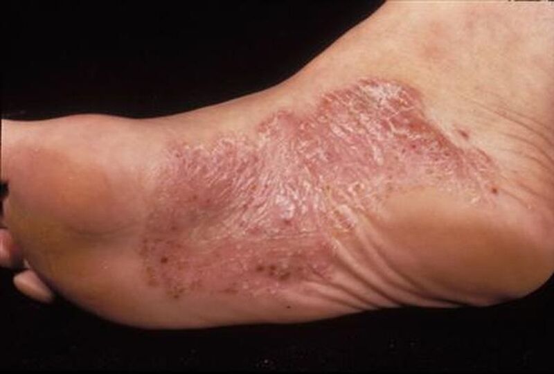 Fuß-Psoriasis-Symptome