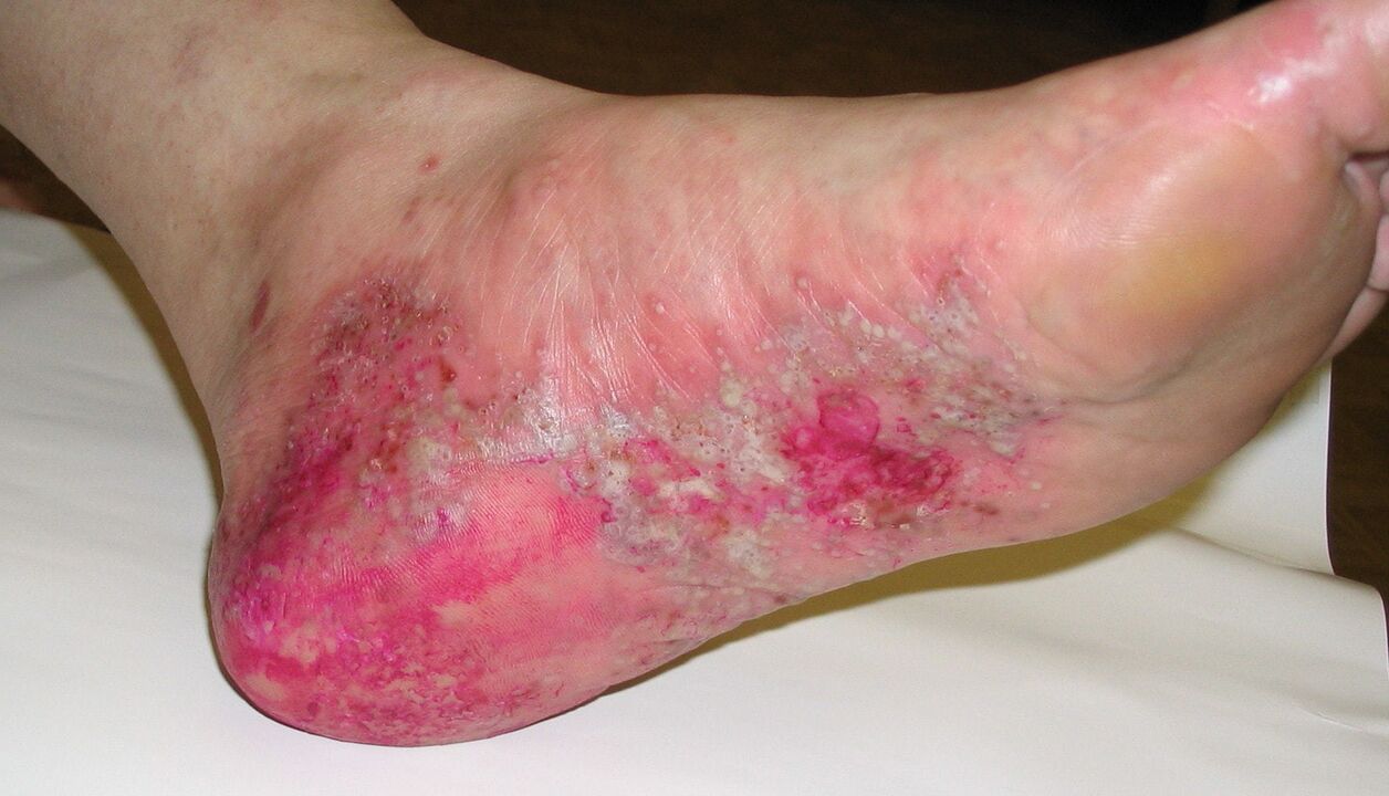Fuß-Psoriasis