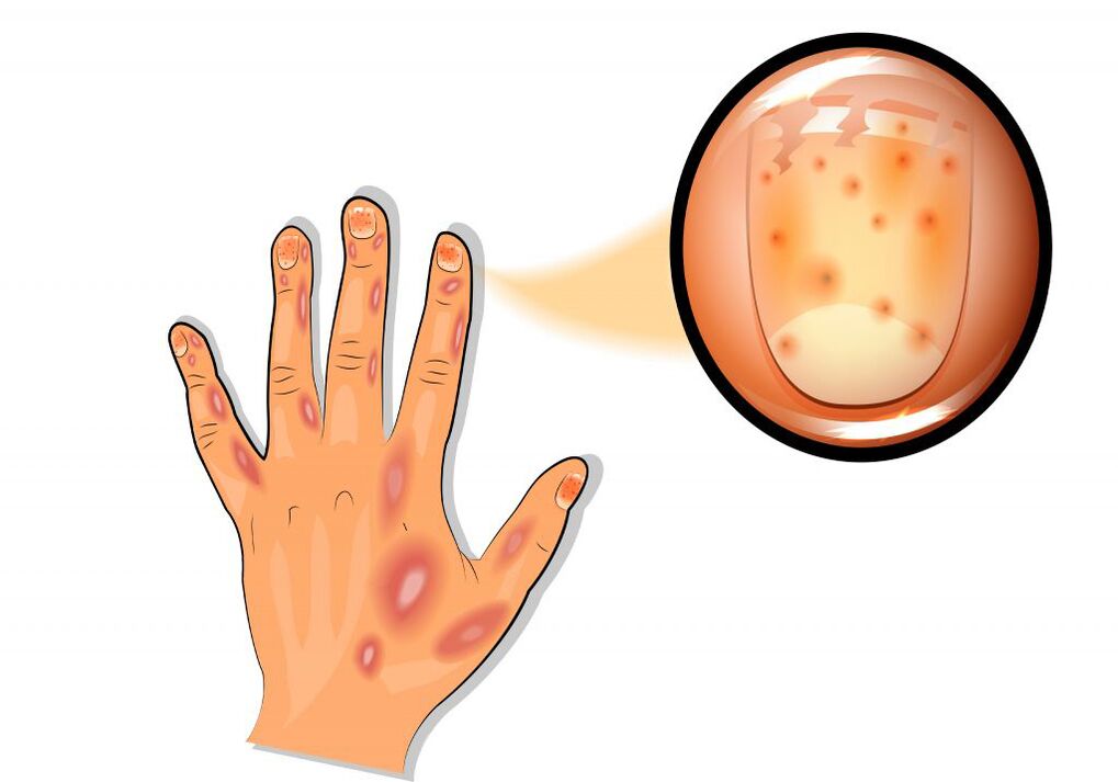 Schäden an den Nägeln bei Psoriasis