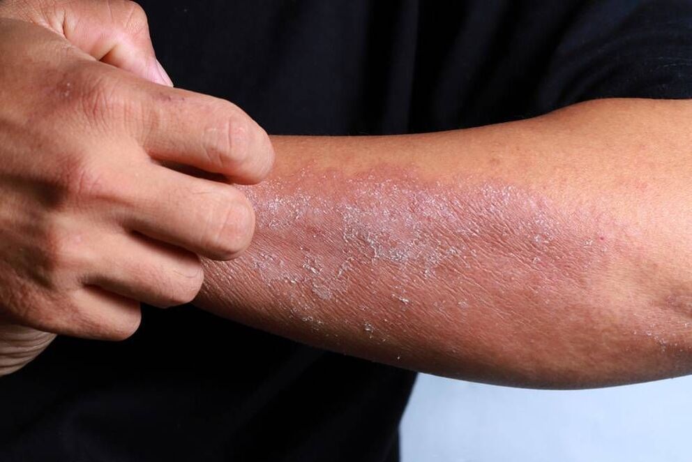 Symptome der Haut-Psoriasis