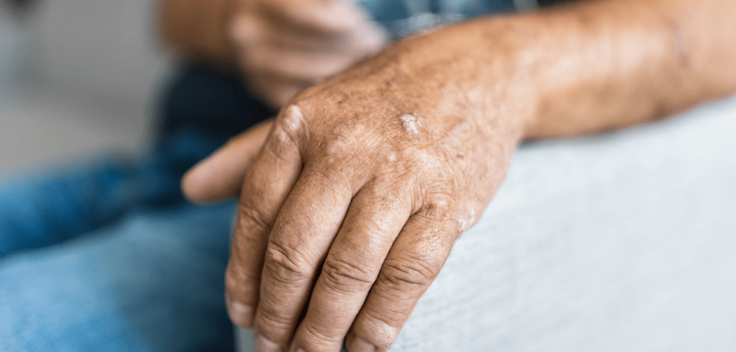 Psoriasis auf der Haut der Hand