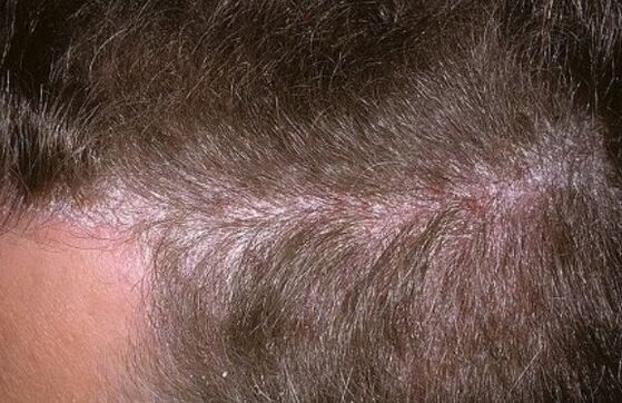 Psoriasis am Kopf