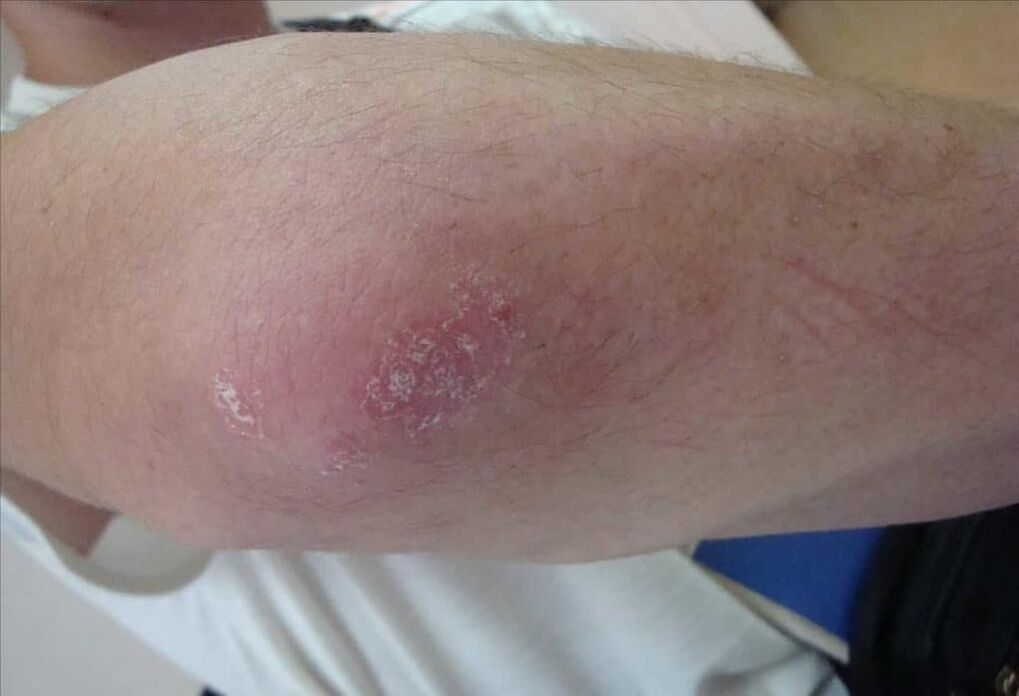 Was für eine Psoriasis tut