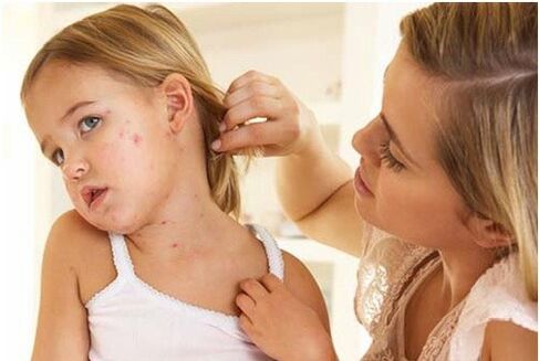 Psoriasis bei Kindern