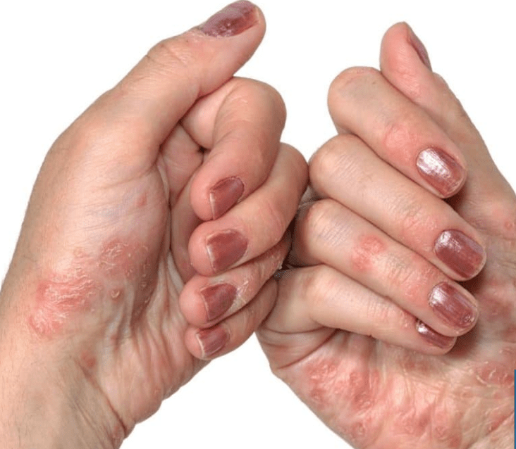Psoriasis in den Händen