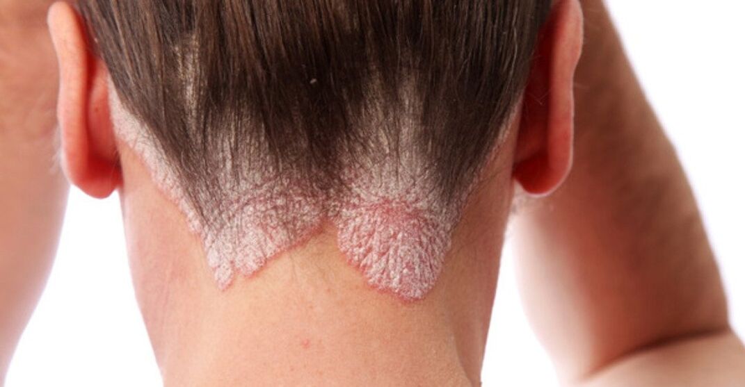Psoriasis auf den Köpfen der Mädchen