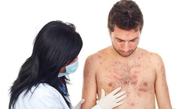 Foto der Psoriasis