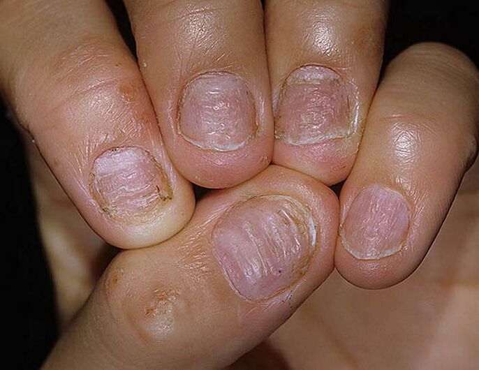 Nagel -Psoriasis