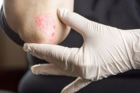 Psoriasis am Ellbogen