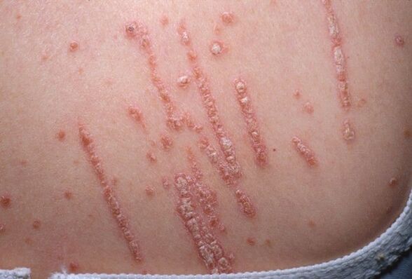 Psoriasis am Körper