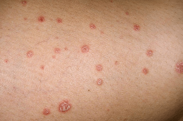 Psoriasis-Plaques