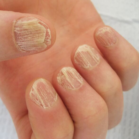 Nagelschäden durch Psoriasis