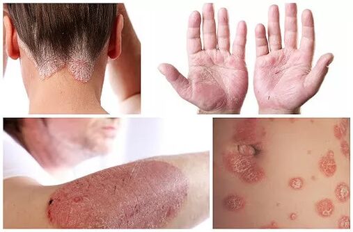 Manifestationen der Psoriasis an verschiedenen Stellen des Körpers