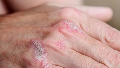 Symptome der Anfangsphase der Psoriasis
