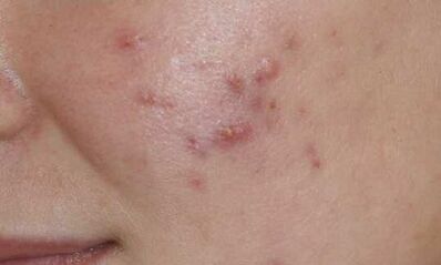 Symptome der Anfangsphase der Psoriasis