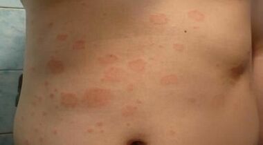 Wie erkennt man das Anfangsstadium der Psoriasis