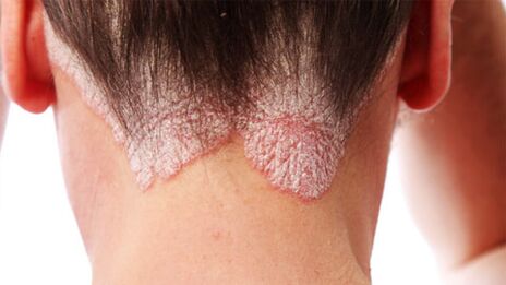 Psoriasis-Plaques auf der Kopfhaut