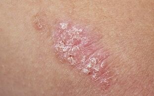 Ursachen der Psoriasis