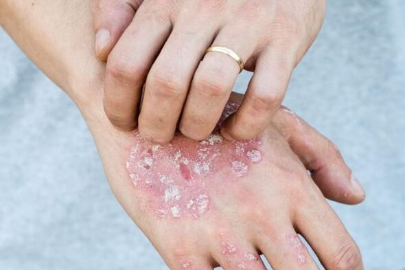 Charakteristische Symptome einer Psoriasis an den Händen
