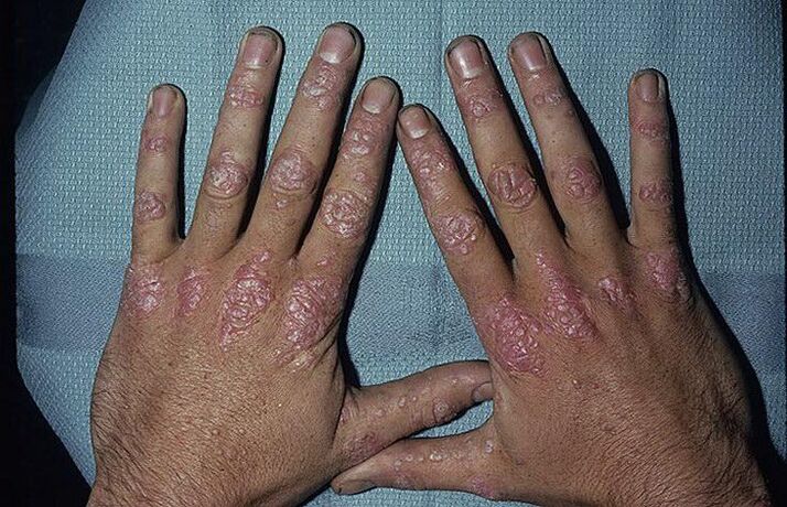 Gründe für die Entwicklung einer Psoriasis an den Händen
