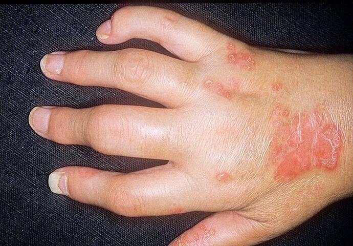 Psoriasis-Arthritis an den Händen