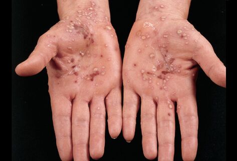 Wie Psoriasis auf Ihren Handflächen aussieht