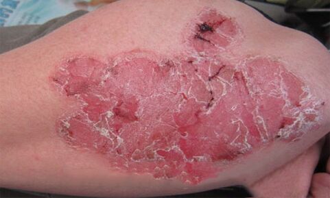 Wie Pustelpsoriasis auf der Haut aussieht