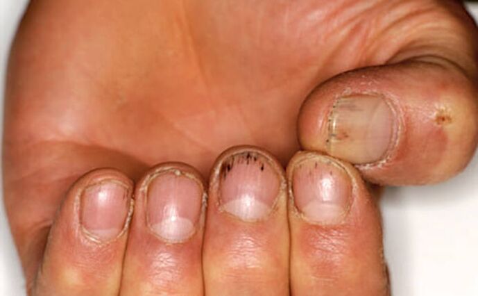 Blutungen unter den Nägeln mit Psoriasis