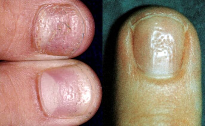 Symptom der Fingerhut mehrfache Vertiefungen auf der Oberfläche der Nagelplatte