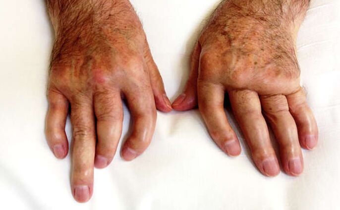 Verstümmelnde Arthritis bei Psoriasis
