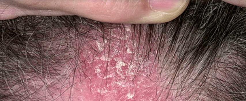 Hautläsionen auf der Kopfhaut mit Psoriasis